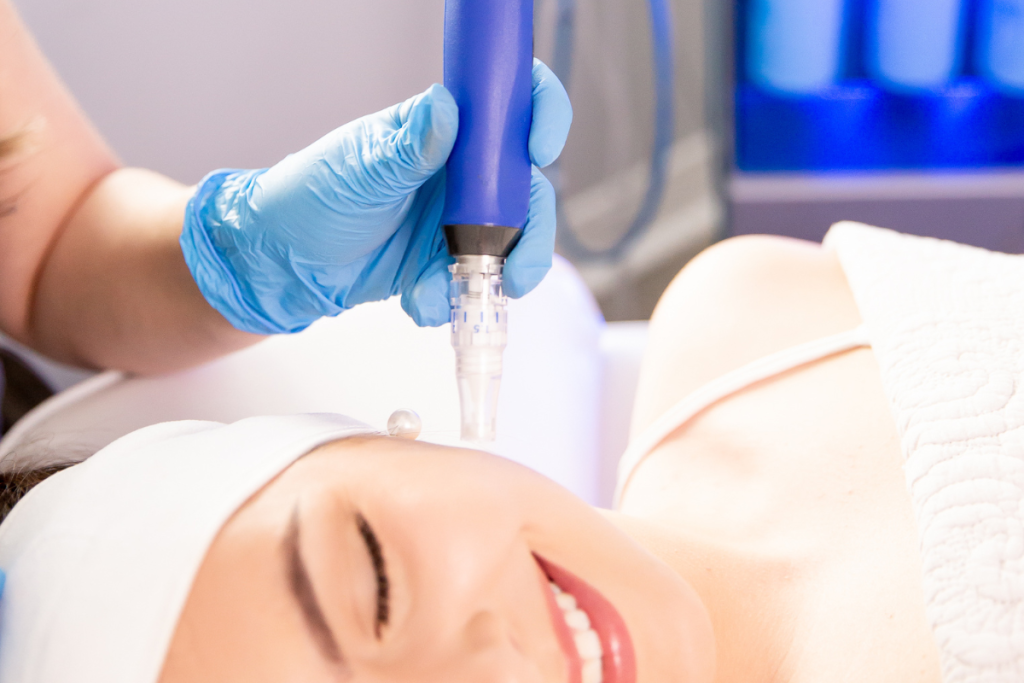 microneedling 3